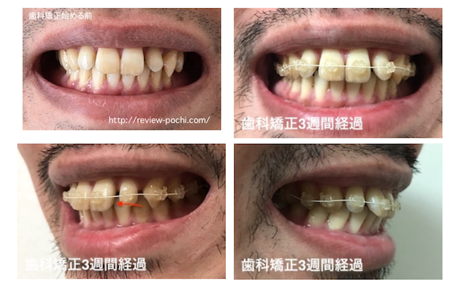 出っ歯 歯科矯正 3週間経過後の写真 痛みとか諸々について ポチレビュー