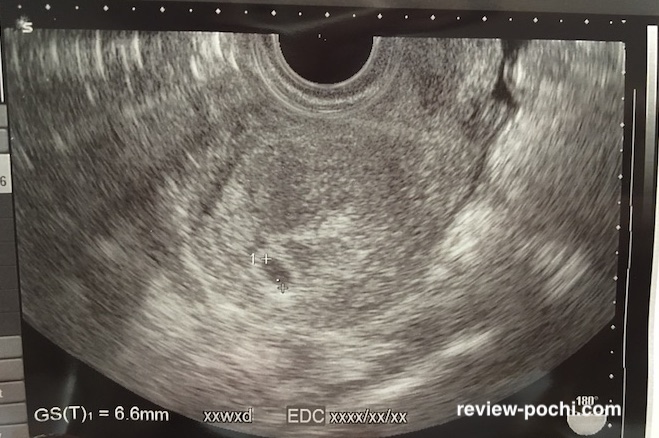 胎嚢確認してきました 大きさや出血の有無 次の心拍確認までの日数など 妊娠レポート ポチレビュー